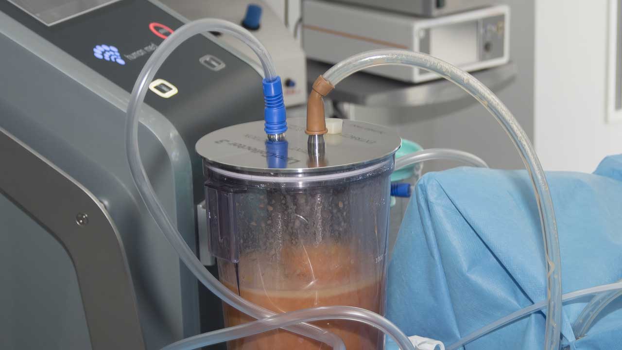 Liposuccion Body jet en Tunisie prix pas cher Liposuccion Body jet