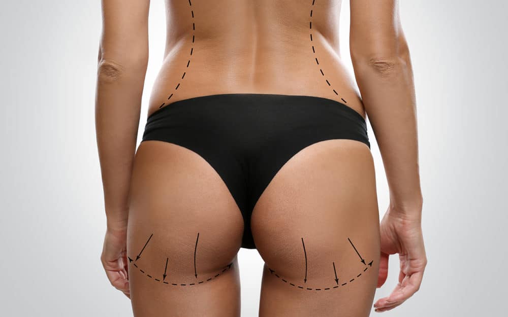 Lipofilling Fessiers en Tunisie prix pas cher Lipofilling Fessiers