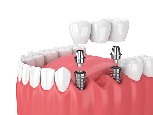 Traitement bridge dentaire 