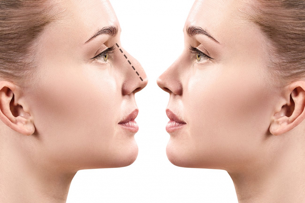 Rhinoplastie: chirurgie du nez en Tunisie prix pas cher Rhinoplastie: chirurgie du nez