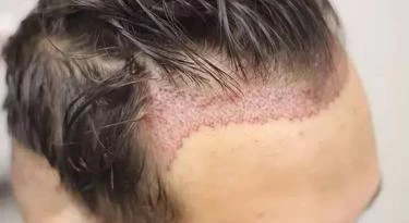 Autotrapianto capelli tecnica FUE Tunisia o Turchia prezzi in Tunisia Turchia Prezzo Autotrapianto capelli tecnica FUE Tunisia o Turchia prezzi in Tunisia Turchia Prezzo