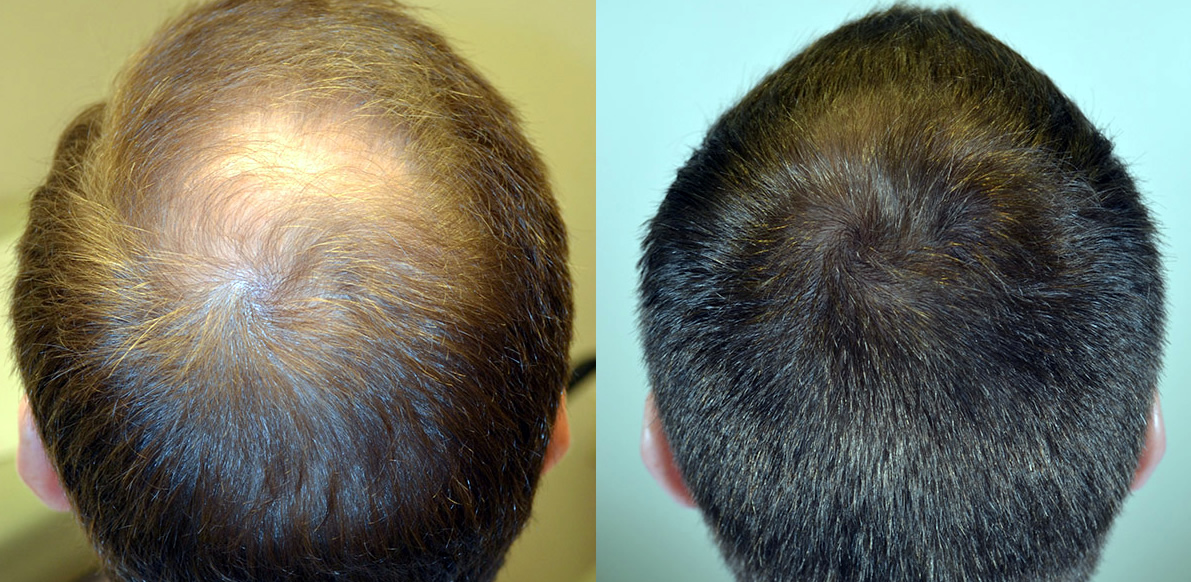 Trapianto Trapianto capelli prp Tunisia o Turchia costo e prezzi in Tunisia Turchia Prezzo
