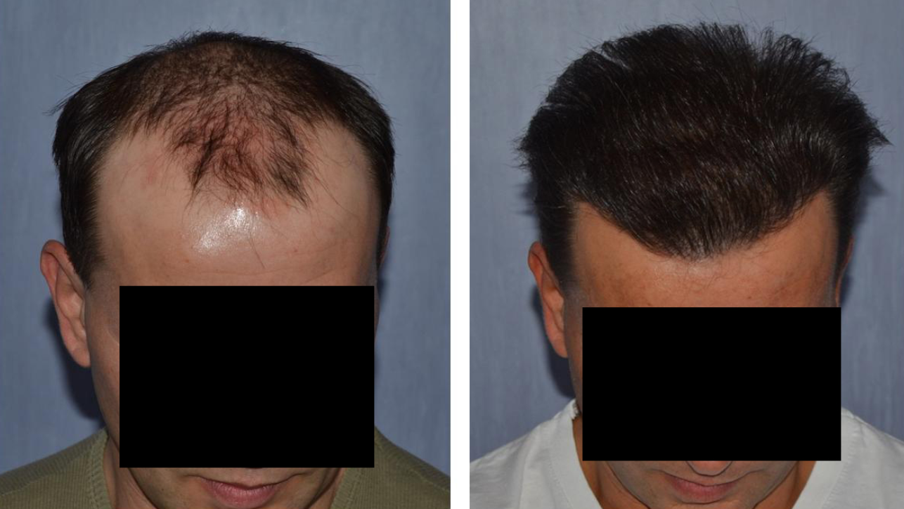 Trapianto Trapianto capelli FUT Tunisia o Turchia costo e prezzi in Tunisia Turchia Prezzo