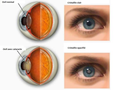 La chirurgie de la cataracte