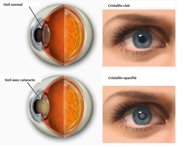 cataracte