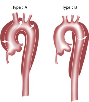 La dissection aortique