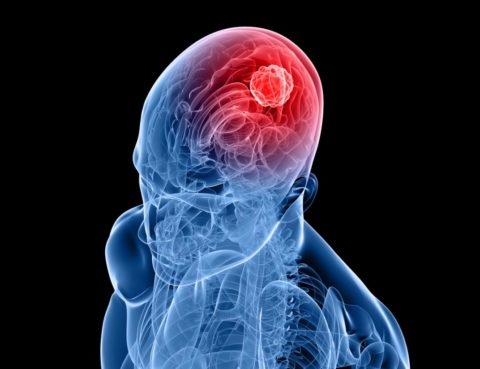 Les tumeurs intracrâniennes