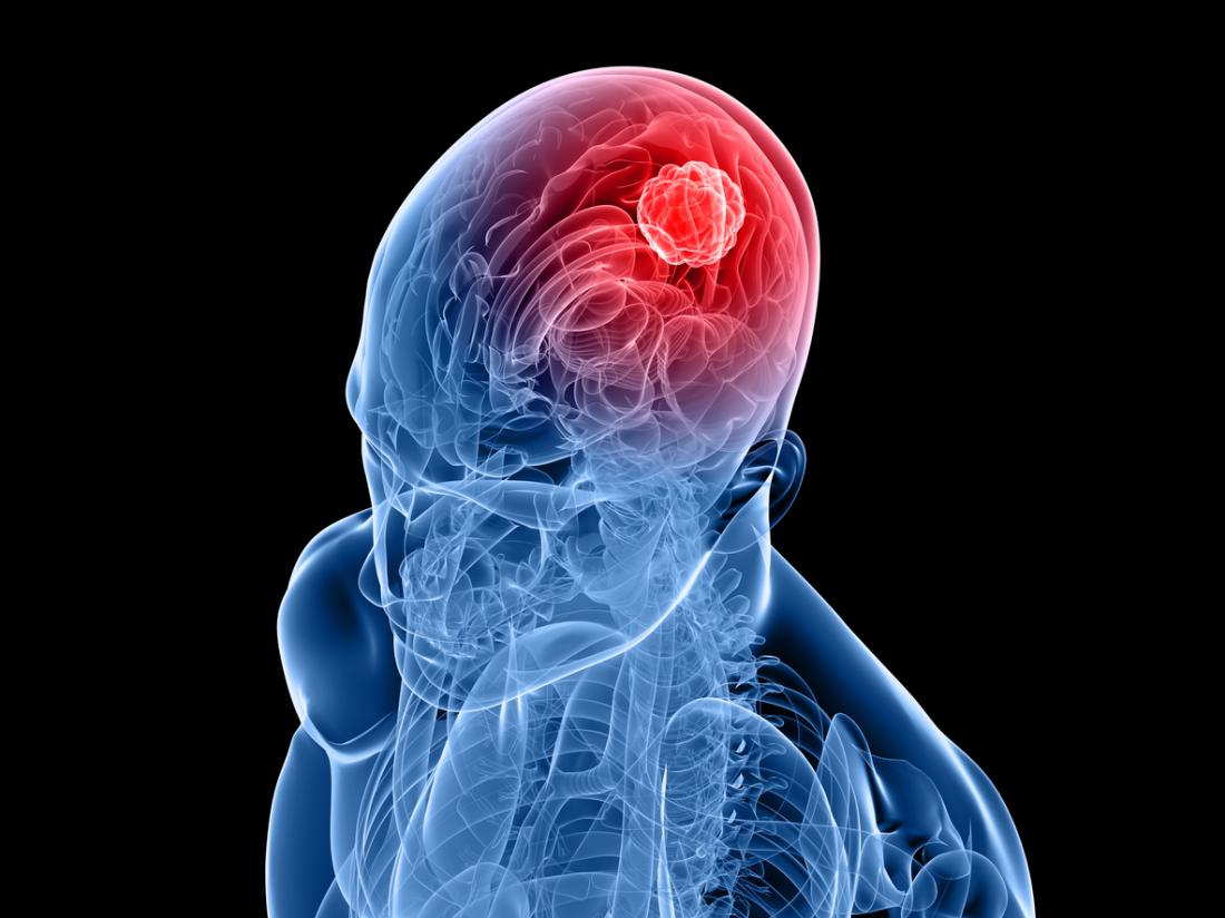 Les tumeurs intracrâniennes