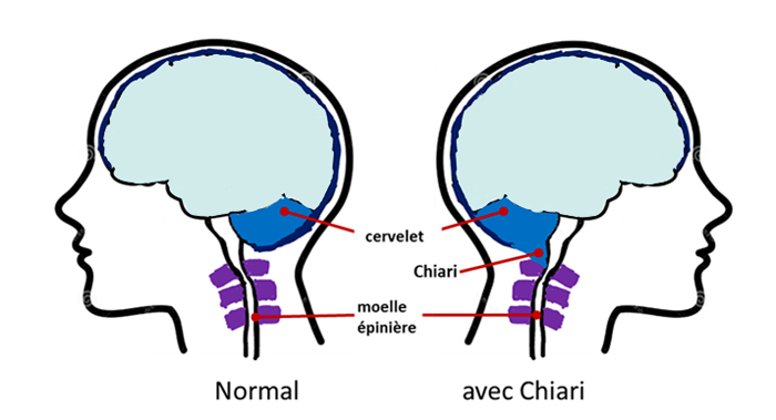La malformation de Chiari
