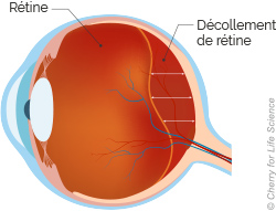 Le décollement de rétine