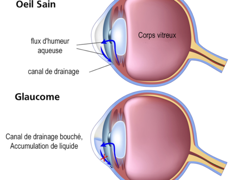 La chirurgie des glaucomes
