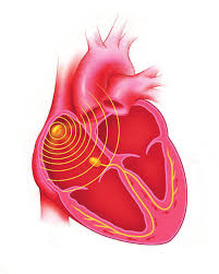 Thérapie de resynchronisation cardiaque