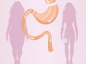  Gastric Band Surgery
