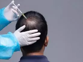  العلاج الهرموني لفقدان الشعر
