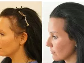 Chirurgie Esthétique Turquie Abaissement de la ligne frontale