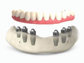  Информация, цены и общая стоимость Имплантация зубов All-on-6 