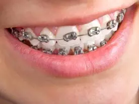  Info, prices & total cost Braces