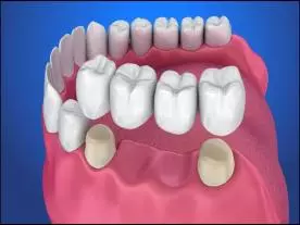 Chirurgie Esthétique Turquie Bridge Dentaire