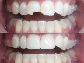  Info, prices & total cost Tooth crown