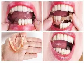 Info, prices & total cost Denture