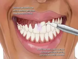 Chirurgie Esthétique Turquie Gingivectomie