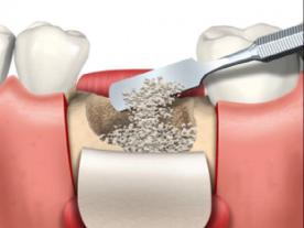  Dental bone graft