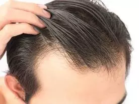  زراعة الشعر