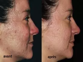 Chirurgie Esthétique Turquie Injection de PRP visage