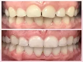  تقويم الأسنان الشفاف