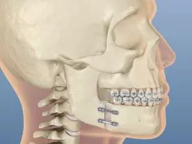  Info, prices & total cost Jaw surgery