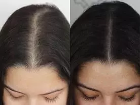 Chirurgie Esthétique Turquie PRP pour la perte de cheveux