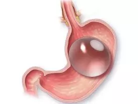  Info, prices & total cost Gastric balloon