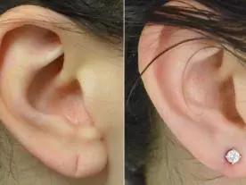 Chirurgie Esthétique Turquie Réparation de trou de boucle d'oreille 