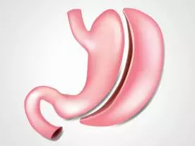  Info, prices & total cost Gastric Sleeve