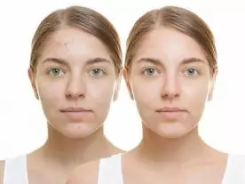 Chirurgie Esthétique Turquie Traitement de l’acné au laser