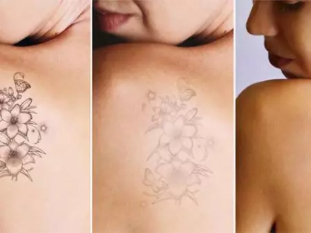  Laser tattoo removal