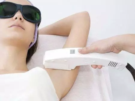  Laser Hair Removal