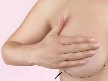  Breast implants