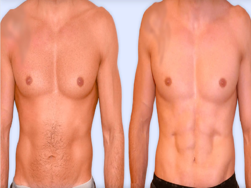  Photos: Before / After 0 in Turkey Abdominal Etching, Turkey, Istanbul, price, stomach, sculpting, carving, liposuction, abs