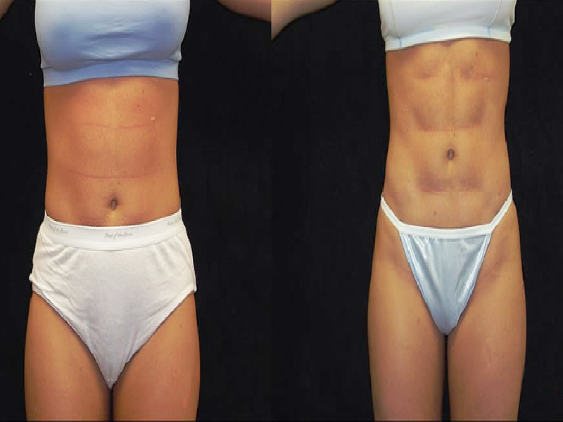 Difference Between Liposuction & Abdominal Etching