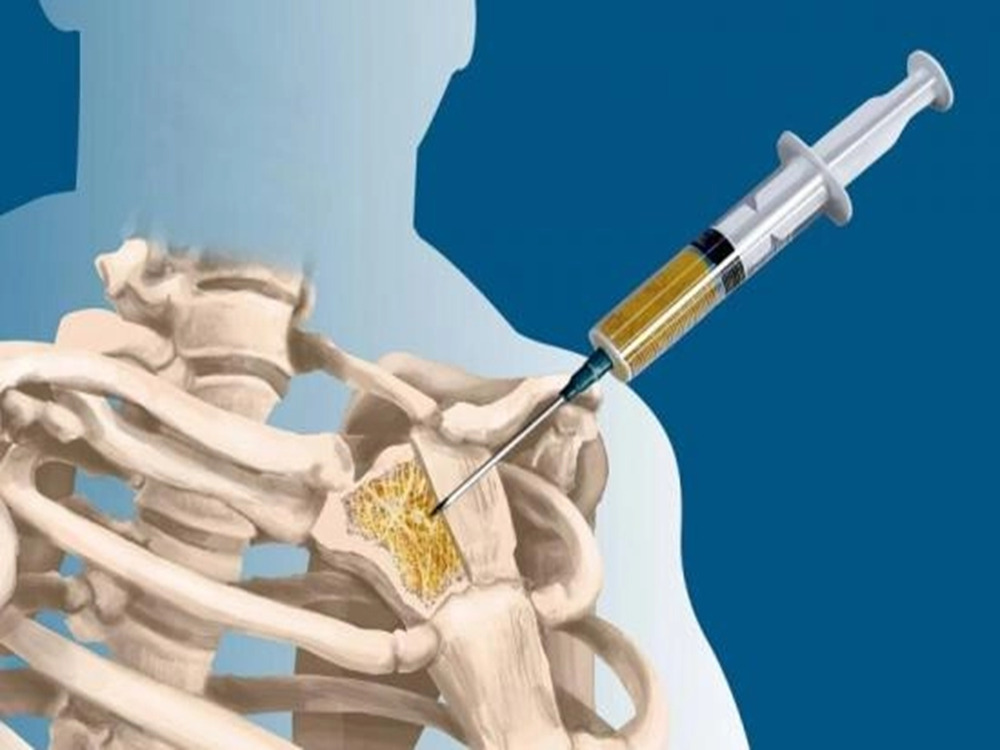 Tratamiento del cáncer de médula ósea