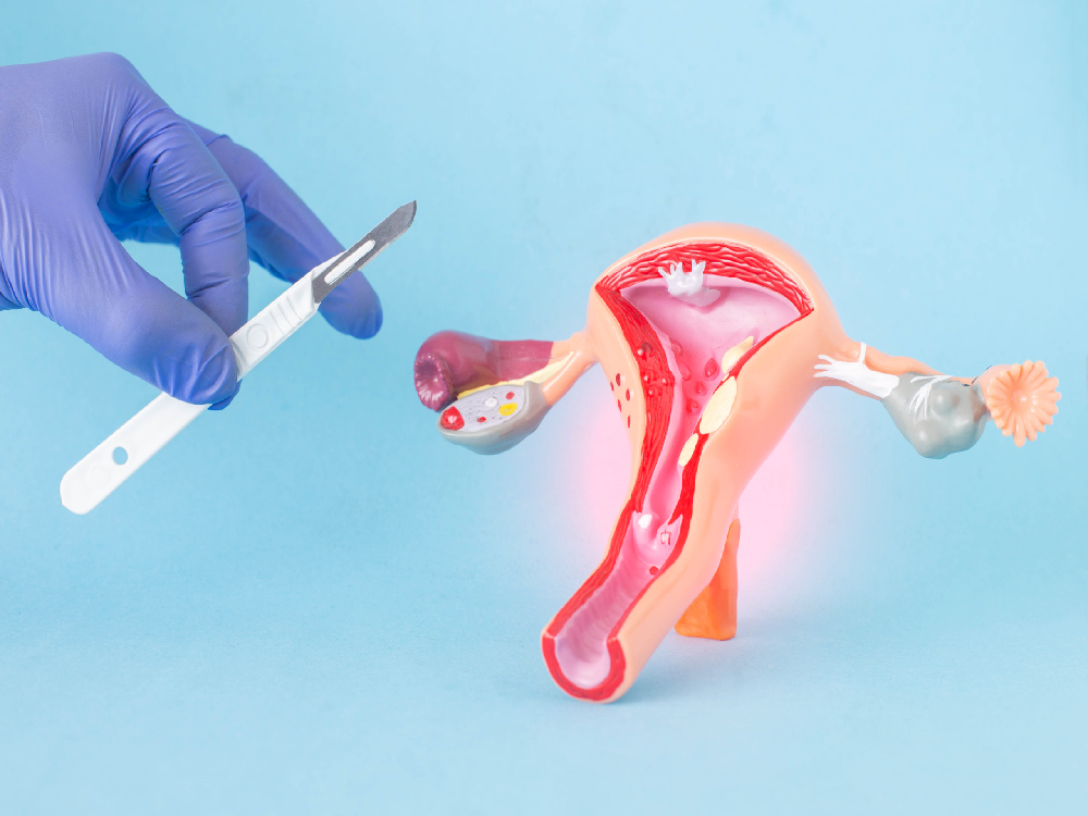 Treatment of cervical polyps