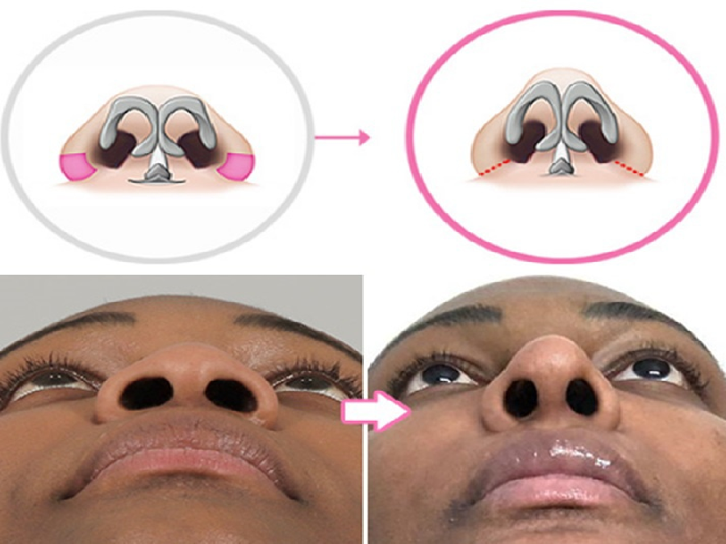 Alarplasty (reduction of the nostrils) Turkey 