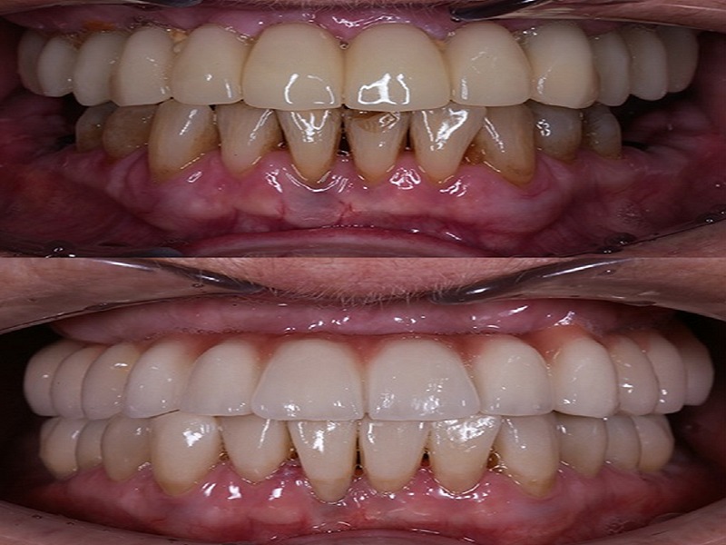 Photos: Before / After 0 in Turkey Dental implants, Istanbul, Turkey, cost, All on four, clinic, orthodontist