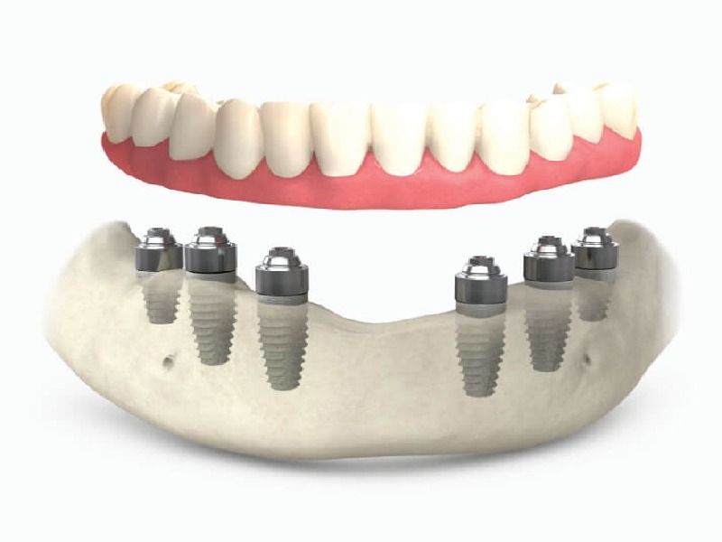  Pasos, costos y revisiones de todos los 6 implantes dentales en Turquía 2024