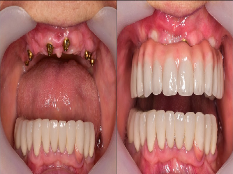 Upper ALL ON 6 before After Turkey Istanbul