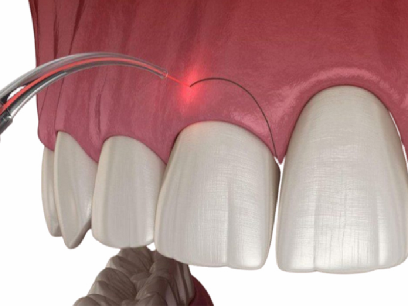 Tooth crown lengthening target 2024