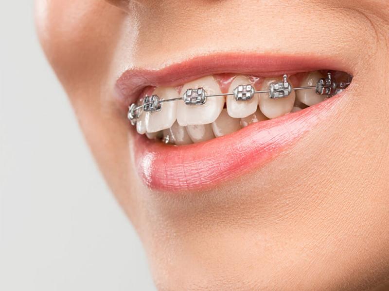 Types of braces in Turkey 2024