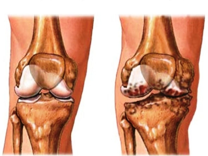 Osteoarthritis treatment Turkey 