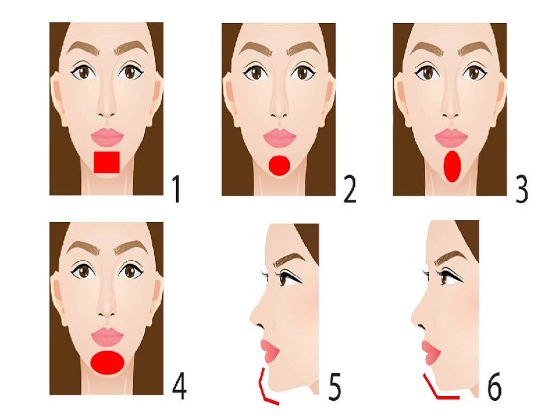 Chin augmentation 6 Turkey Chin augmentation 6 Turkey